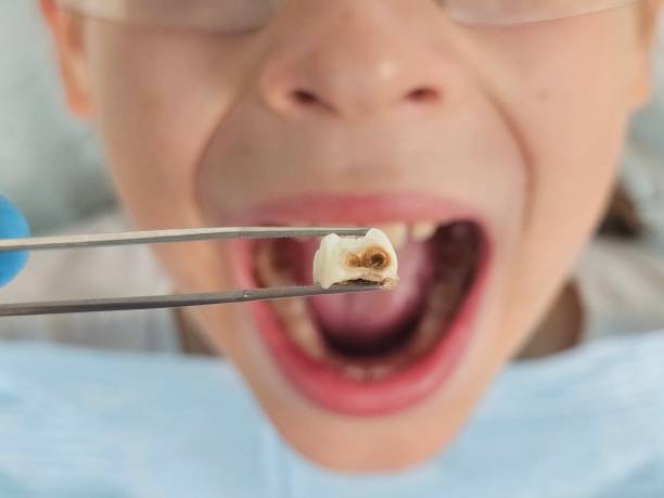 Best Emergency Dental Extractions in Hilmar Irwin, CA