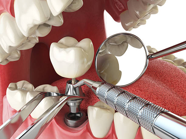 Best Emergency Dentist for Lost Fillings or Crowns in Hilmar Irwin, CA