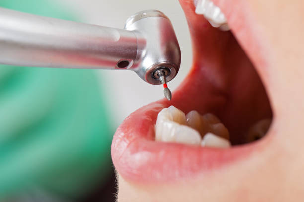 Best Emergency Dentist for Knocked-Out Tooth in Hilmar Irwin, CA
